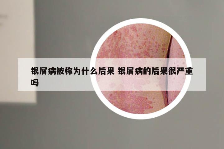 银屑病被称为什么后果 银屑病的后果很严重吗