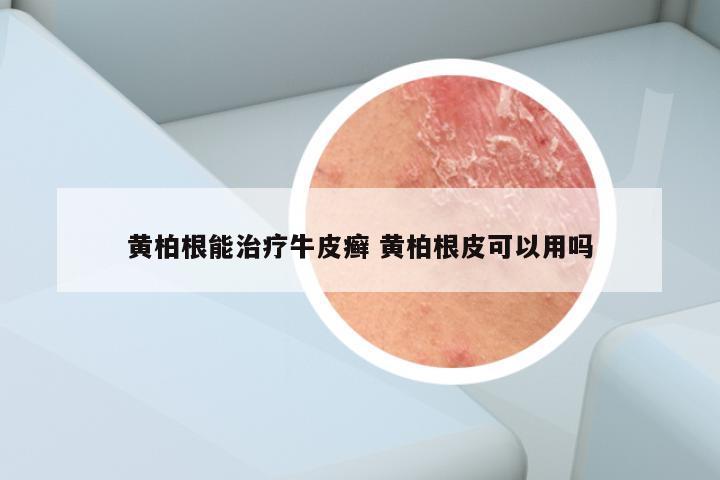 黄柏根能治疗牛皮癣 黄柏根皮可以用吗