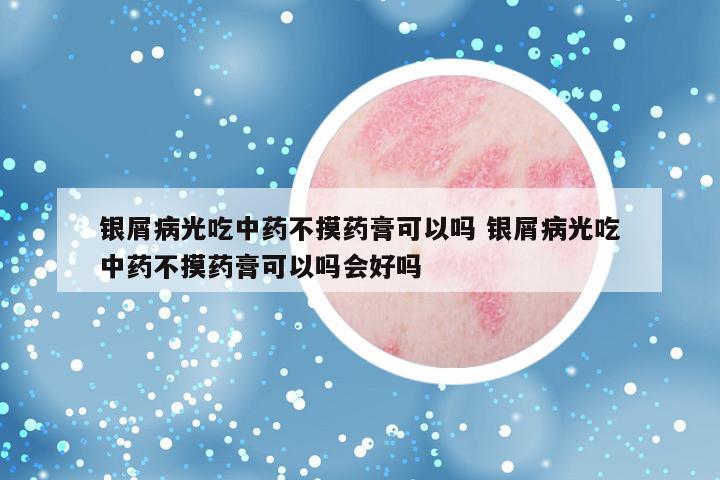 银屑病光吃中药不摸药膏可以吗 银屑病光吃中药不摸药膏可以吗会好吗