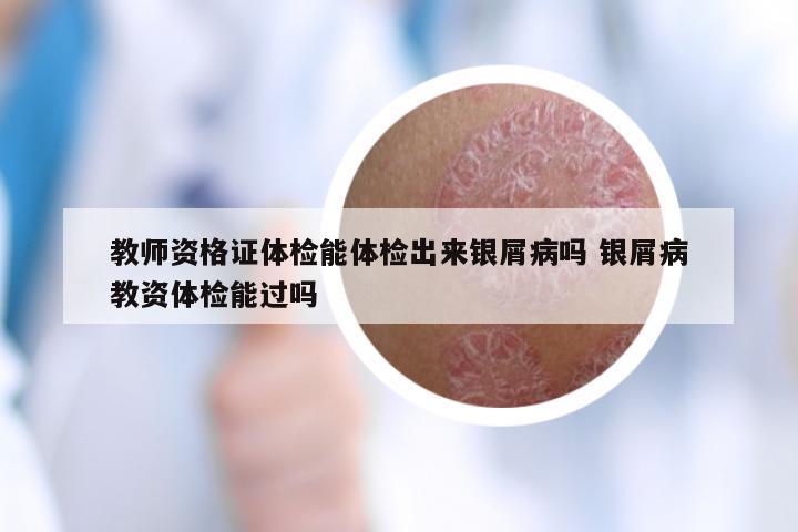 教师资格证体检能体检出来银屑病吗 银屑病教资体检能过吗