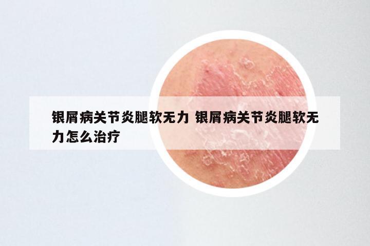 银屑病关节炎腿软无力 银屑病关节炎腿软无力怎么治疗