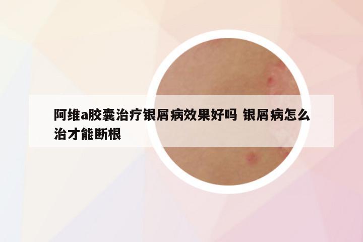 阿维a胶囊治疗银屑病效果好吗 银屑病怎么治才能断根