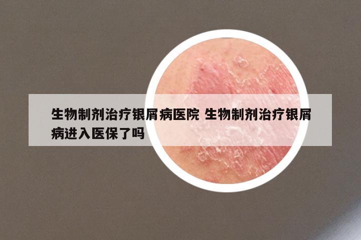 生物制剂治疗银屑病医院 生物制剂治疗银屑病进入医保了吗