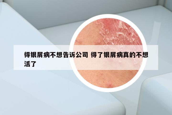 得银屑病不想告诉公司 得了银屑病真的不想活了