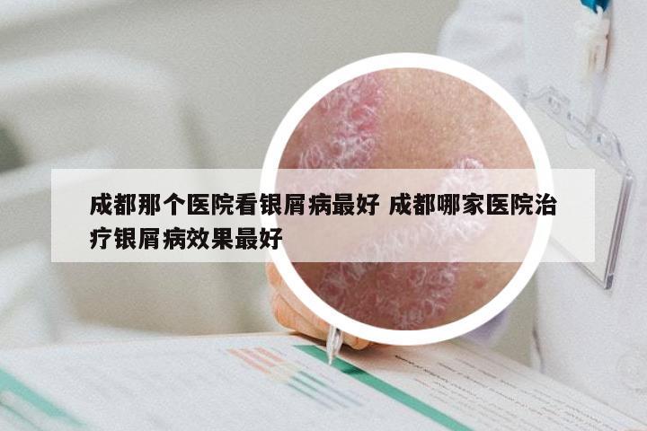 成都那个医院看银屑病最好 成都哪家医院治疗银屑病效果最好