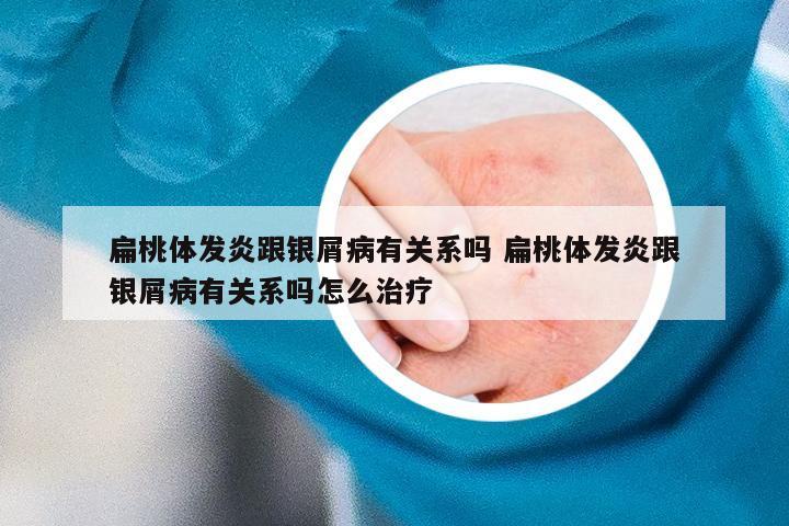 扁桃体发炎跟银屑病有关系吗 扁桃体发炎跟银屑病有关系吗怎么治疗