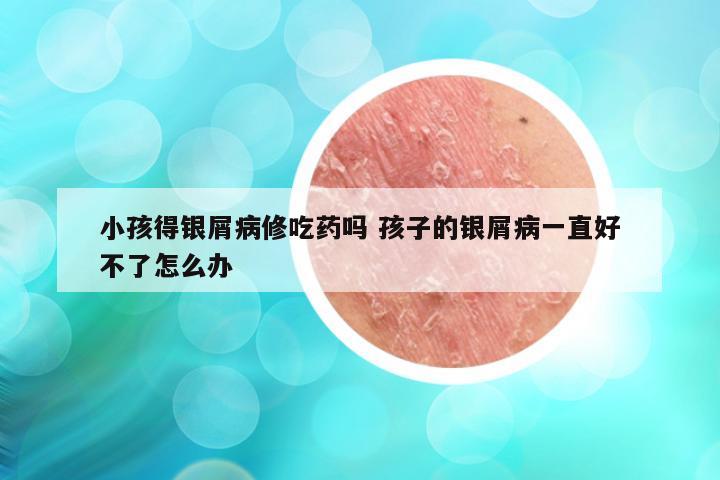 小孩得银屑病修吃药吗 孩子的银屑病一直好不了怎么办