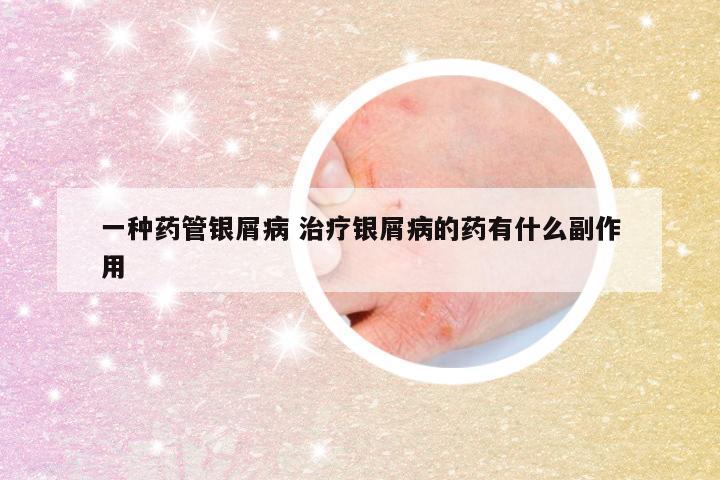 一种药管银屑病 治疗银屑病的药有什么副作用