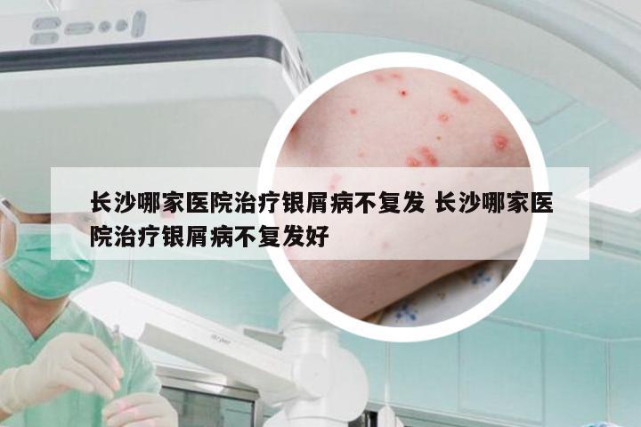 长沙哪家医院治疗银屑病不复发 长沙哪家医院治疗银屑病不复发好