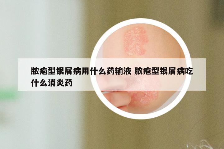 脓疱型银屑病用什么药输液 脓疱型银屑病吃什么消炎药