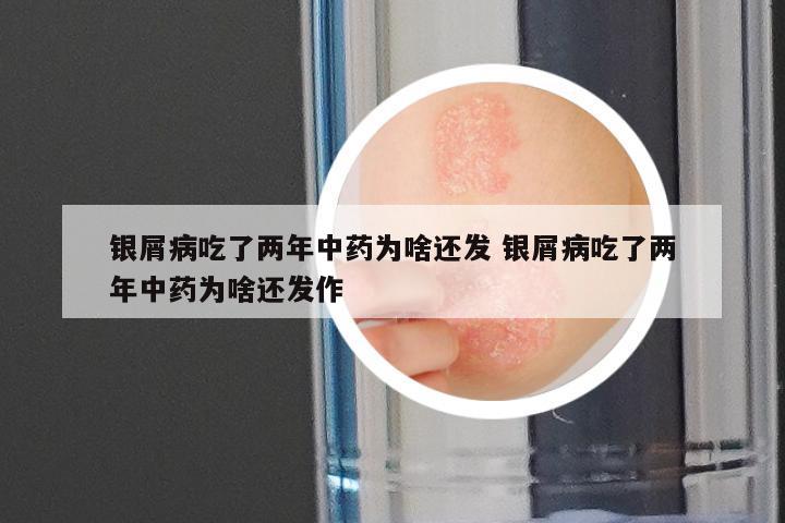 银屑病吃了两年中药为啥还发 银屑病吃了两年中药为啥还发作