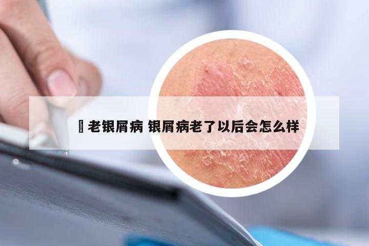 禤老银屑病 银屑病老了以后会怎么样