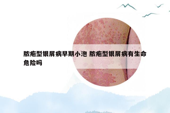 脓疱型银屑病早期小泡 脓疱型银屑病有生命危险吗