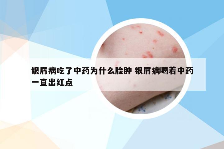 银屑病吃了中药为什么脸肿 银屑病喝着中药一直出红点