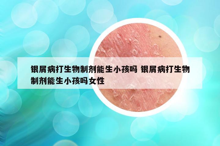 银屑病打生物制剂能生小孩吗 银屑病打生物制剂能生小孩吗女性