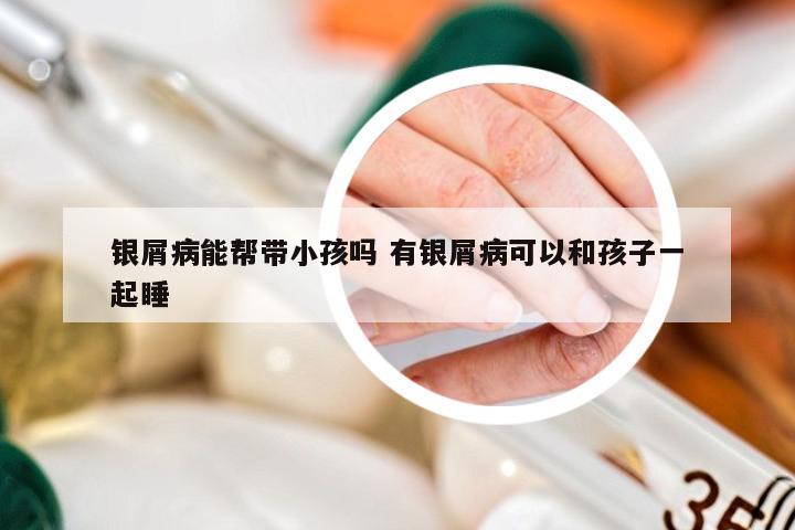 银屑病能帮带小孩吗 有银屑病可以和孩子一起睡