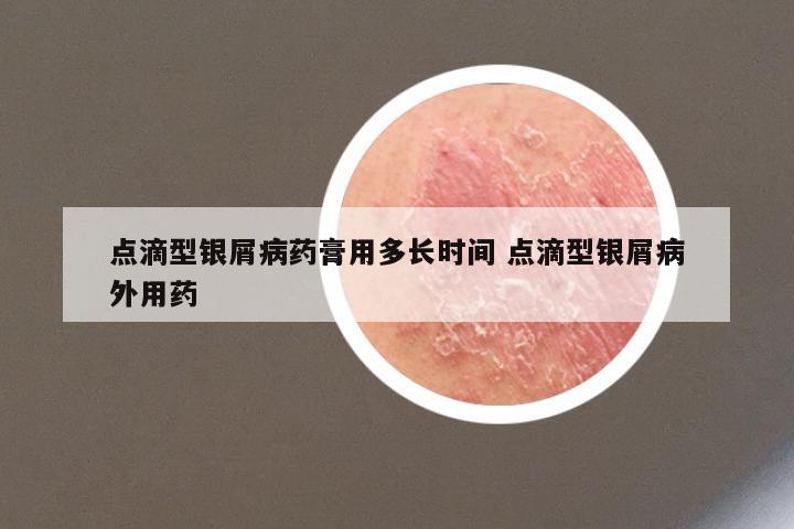 点滴型银屑病药膏用多长时间 点滴型银屑病外用药