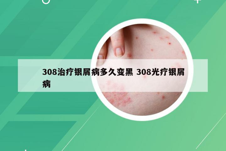 308治疗银屑病多久变黑 308光疗银屑病