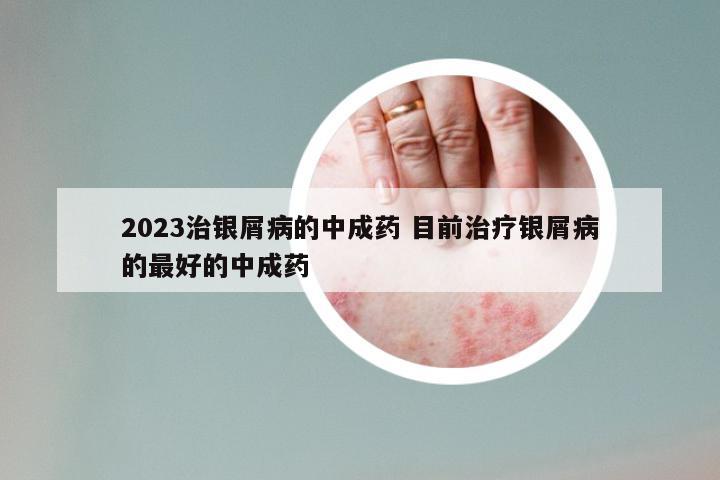 2023治银屑病的中成药 目前治疗银屑病的最好的中成药