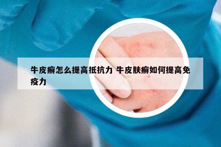 牛皮癣怎么提高抵抗力 牛皮肤癣如何提高免疫力