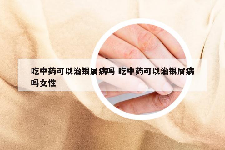 吃中药可以治银屑病吗 吃中药可以治银屑病吗女性