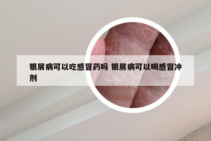 银屑病可以吃感冒药吗 银屑病可以喝感冒冲剂