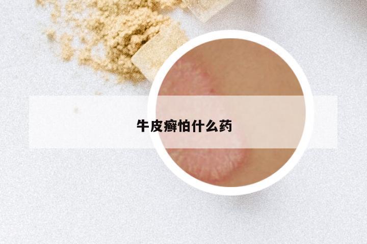 牛皮癣怕什么药