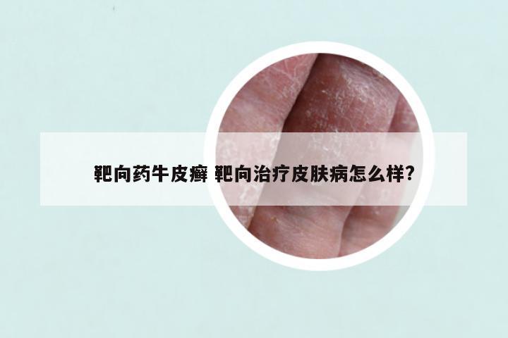 靶向药牛皮癣 靶向治疗皮肤病怎么样?