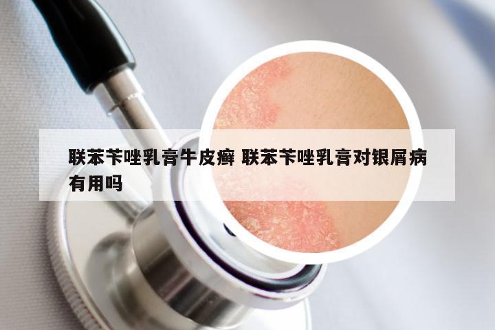 联苯苄唑乳膏牛皮癣 联苯苄唑乳膏对银屑病有用吗