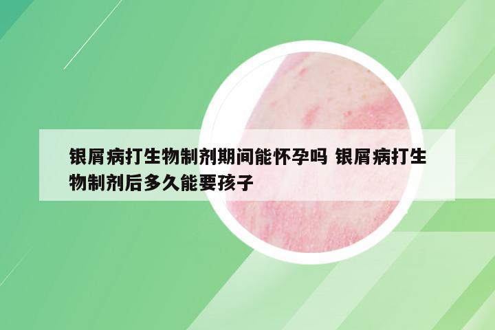 银屑病打生物制剂期间能怀孕吗 银屑病打生物制剂后多久能要孩子