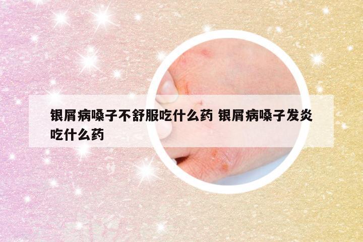 银屑病嗓子不舒服吃什么药 银屑病嗓子发炎吃什么药