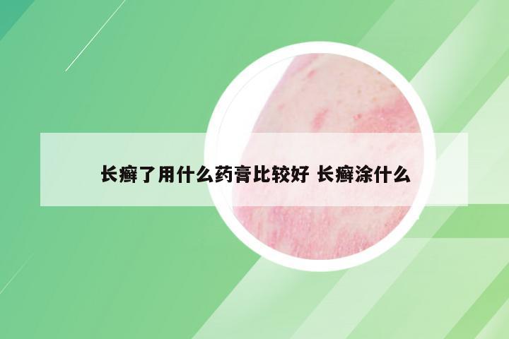 长癣了用什么药膏比较好 长癣涂什么