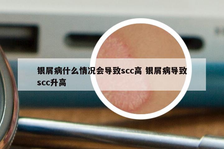 银屑病什么情况会导致scc高 银屑病导致scc升高