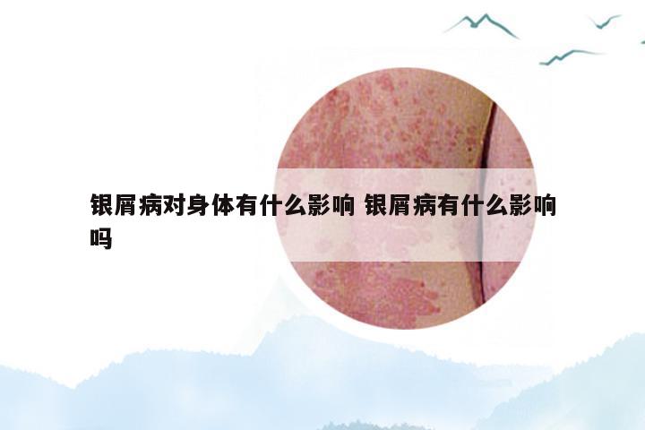 银屑病对身体有什么影响 银屑病有什么影响吗