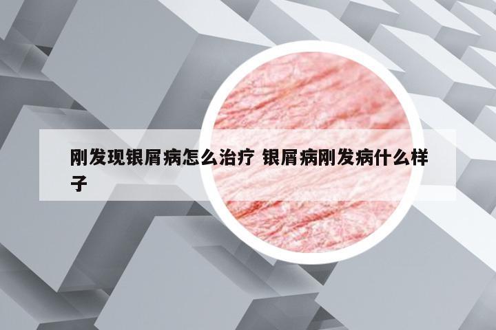 刚发现银屑病怎么治疗 银屑病刚发病什么样子