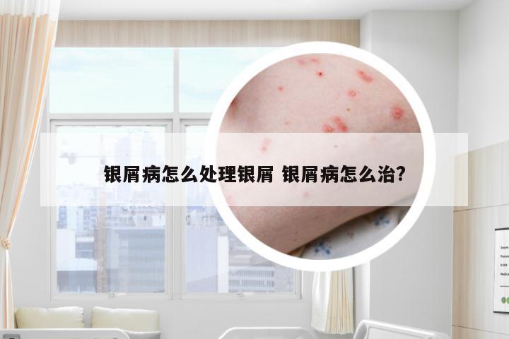 银屑病怎么处理银屑 银屑病怎么治?