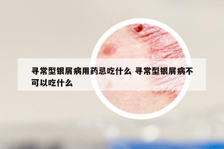 寻常型银屑病用药忌吃什么 寻常型银屑病不可以吃什么