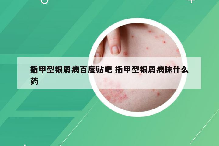 指甲型银屑病百度贴吧 指甲型银屑病抹什么药