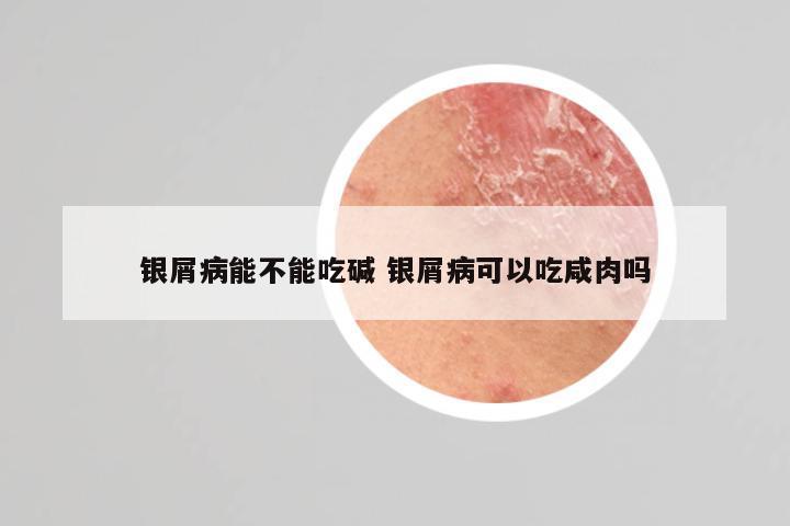 银屑病能不能吃碱 银屑病可以吃咸肉吗