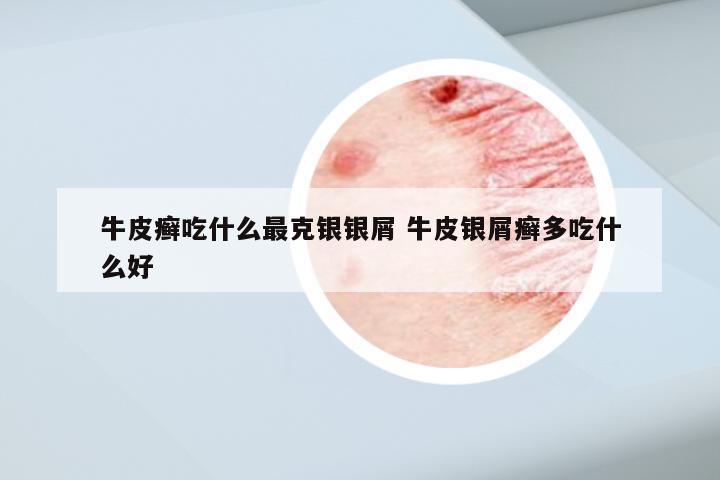 牛皮癣吃什么最克银银屑 牛皮银屑癣多吃什么好