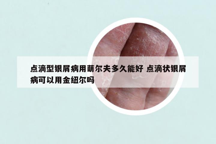 点滴型银屑病用萌尔夫多久能好 点滴状银屑病可以用金纽尔吗