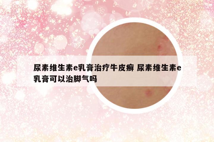 尿素维生素e乳膏治疗牛皮癣 尿素维生素e乳膏可以治脚气吗