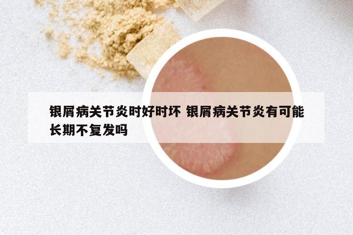 银屑病关节炎时好时坏 银屑病关节炎有可能长期不复发吗