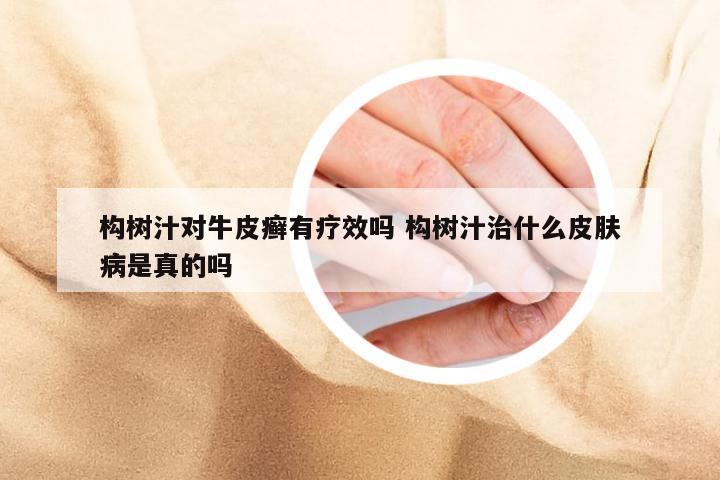 构树汁对牛皮癣有疗效吗 构树汁治什么皮肤病是真的吗