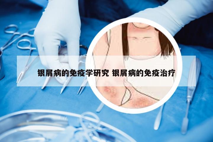 银屑病的免疫学研究 银屑病的免疫治疗