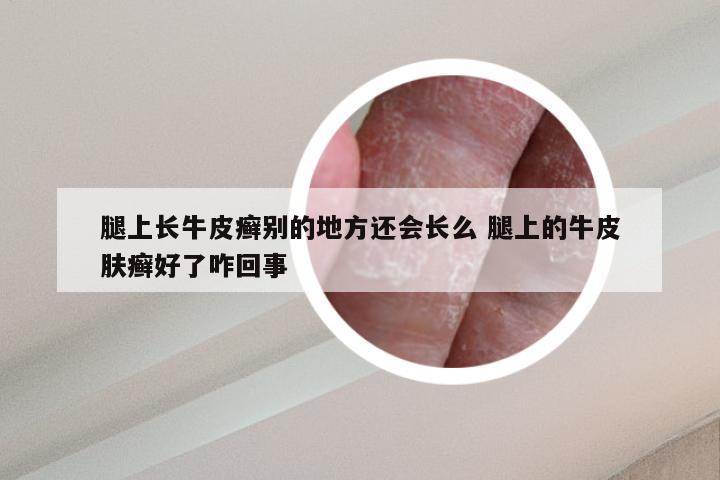 腿上长牛皮癣别的地方还会长么 腿上的牛皮肤癣好了咋回事