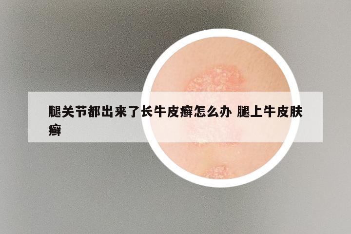 腿关节都出来了长牛皮癣怎么办 腿上牛皮肤癣