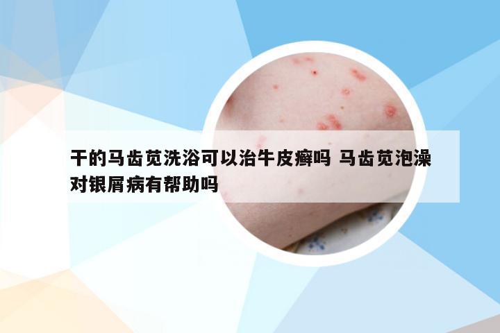 干的马齿苋洗浴可以治牛皮癣吗 马齿苋泡澡对银屑病有帮助吗