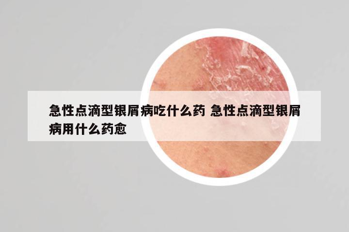 急性点滴型银屑病吃什么药 急性点滴型银屑病用什么药愈