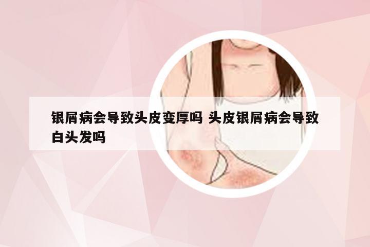 银屑病会导致头皮变厚吗 头皮银屑病会导致白头发吗